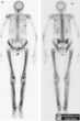 Hypertrophic Osteoarthropathy